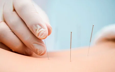 Врач занимается иглоукалыванием